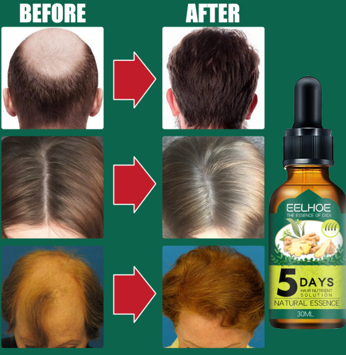 Olio Nutriente Anticaduta Capelli allo Zenzero – 30ML -             Eelhoe Ginger Hair Essential Oil